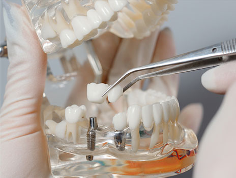 success rate for dental implant