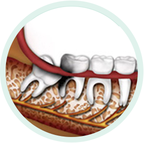 Wisdom tooth symptoms